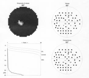 Tünettan - pathmechanizmus Szemtünetek - papilla Átmeneti vizuális bskurációk: (TVO): (13%) (jelzi a kezdődő papillaedémát, ischaemiás flyamatát) a 2.