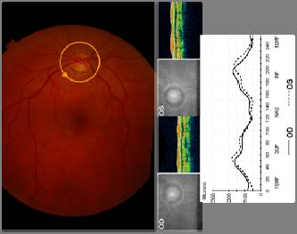 Retina Tmgráfia (HRT) - Scanning Laser