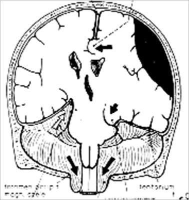 INTRACRANIÁLIS NYOMÁSFOKOZÓDÁS etipathmechanizmus 1. Nrmális ICP < 10 mmhg 2. Súlys fkú nymásfkzódás > 25-30 mmhg 4.