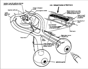 herniati kk:sub-, epiduralis vérzések, tumrk- 4. Infratentrialis térfglalás : ún.