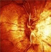 retina thrmbsis Duralis sinus thrmbsis SC-thrmbsis: chemsis, diplpia, prethrmbsis ret.