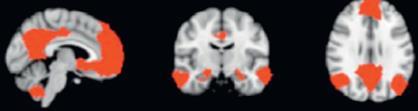Default hálózat Alapja: mpfc, posterior cingulum, medialis temporalis rendszer, gyrus angularis Az introspektív kogníció: Menatlizáció, belső gondolkodással kapcsolatos szemantikus információ