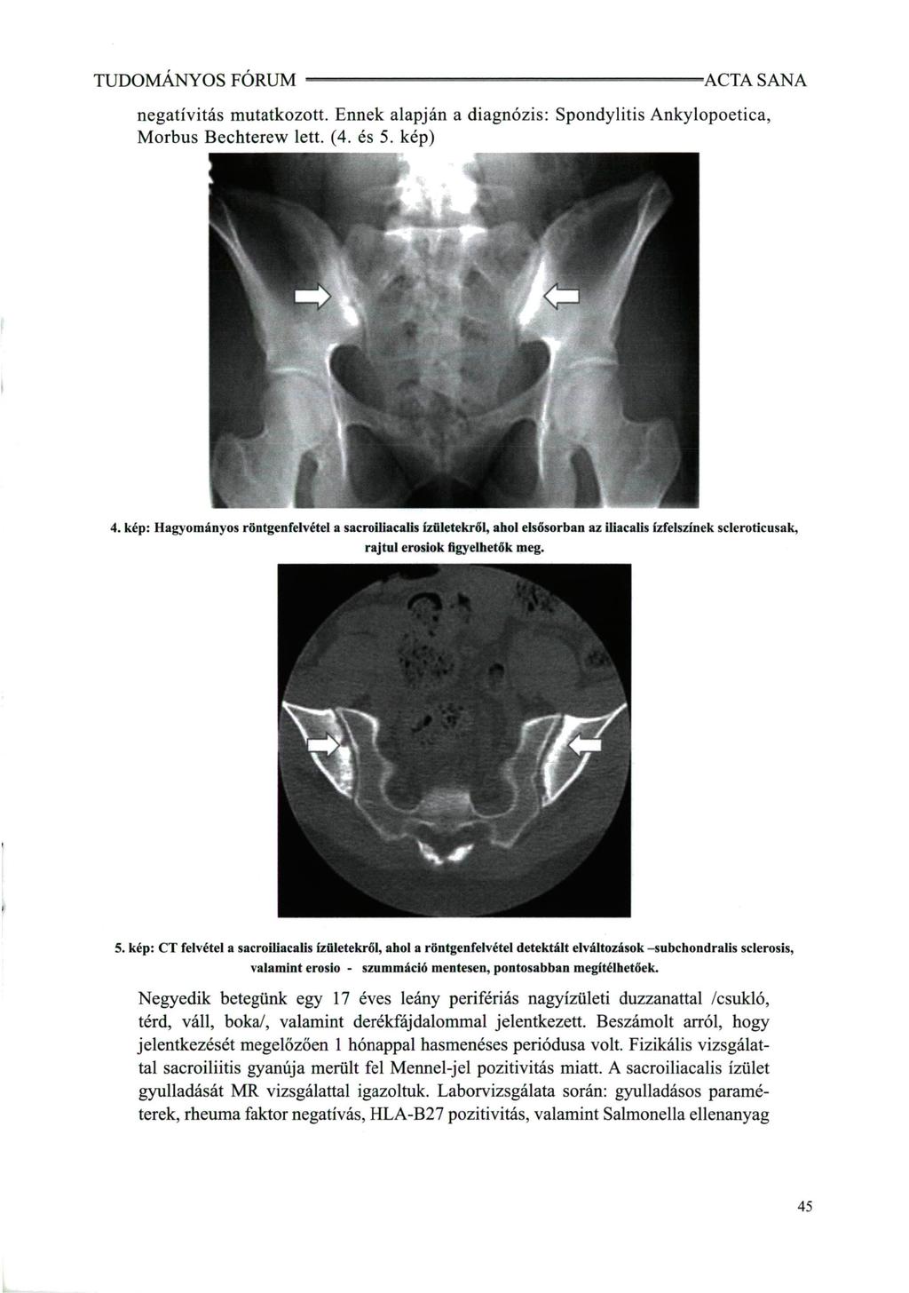 TUDOMÁNYOS FÓRUM negatívitás mutatkozott. Ennek alapján a diagnózis: Spondylitis Ankylopoetica, Morbus Bechterew lett. (4. és 5. kép) m f / f. 4.
