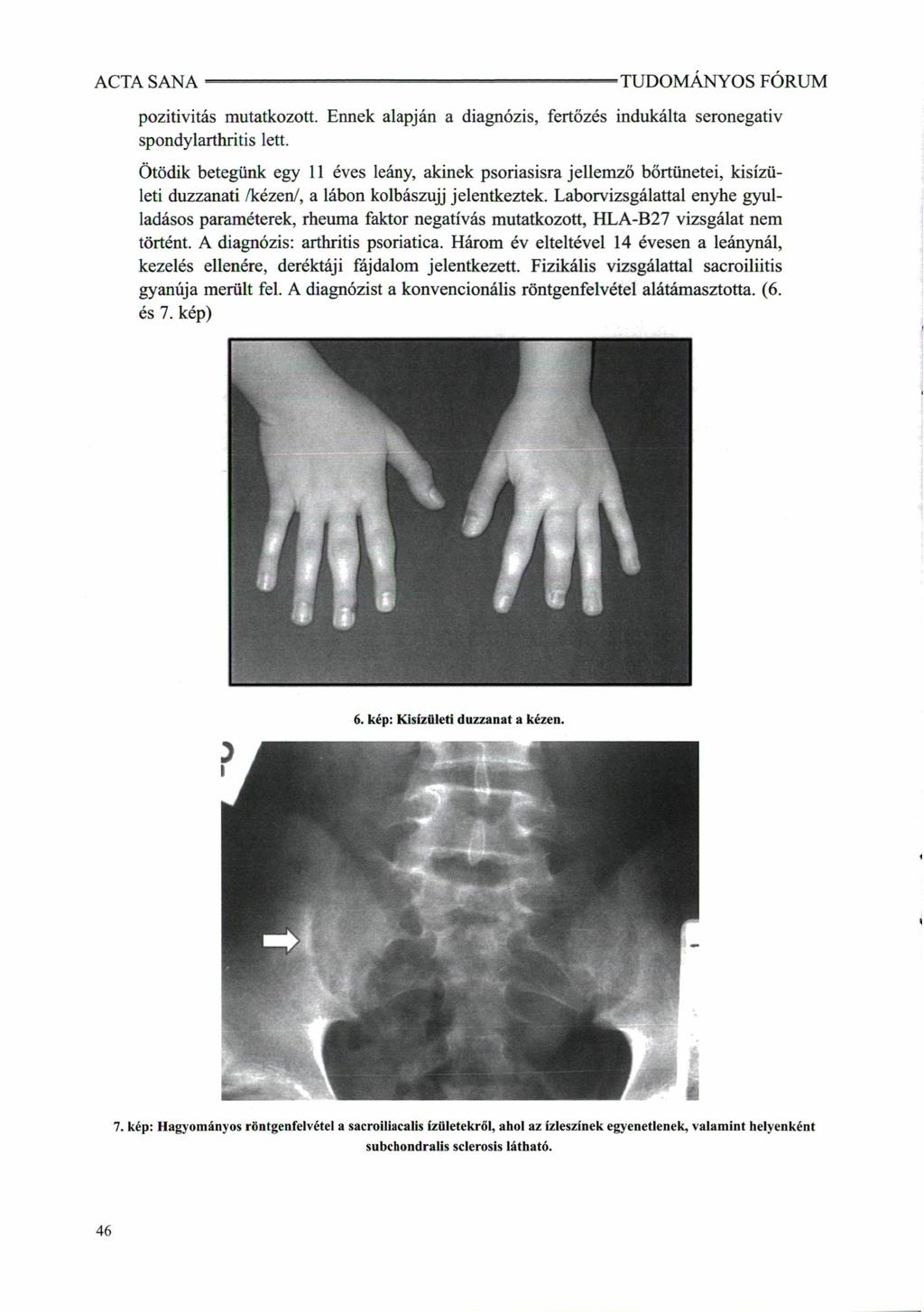 TUDOMÁNYOS FÓRUM pozitivitás mutatkozott. Ennek alapján a diagnózis, fertőzés indukálta seronegativ spondylarthritis lett.