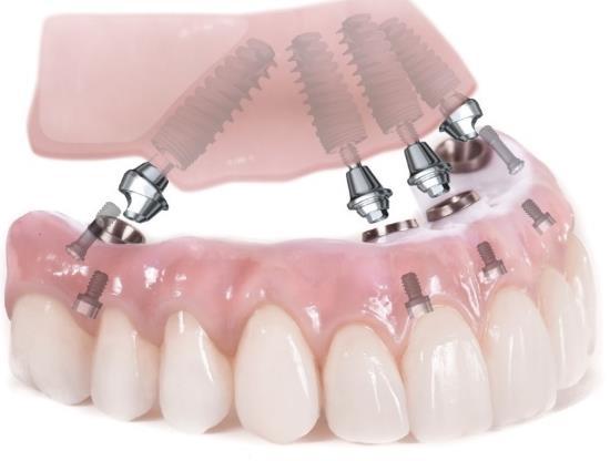 implantátum 12,