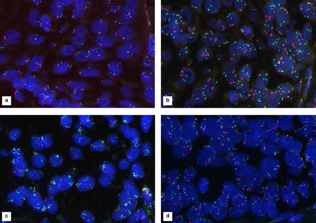 7. ábra: Fluoreszcens in situ hibridizációs vizsgálat reprezentatív mikroszkópos felvételei: PIK3CA gén (zöld) és 3-as kromoszóma centroméra (piros) esetén a) normál génkópiaszám b) és c) PIK3CA