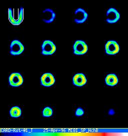 BULLSEYEmozi.gif Máté: Orvosi képalkotás 163 Máté: Orvosi képalkotás 164 A a r rövid tengely metszet (x, y) ρ ϕ A a r kúp palást A : R = a : ρ (a > r π / 2)?