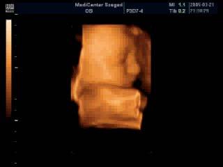 gif Máté: Orvosi képalkotás 235 Máté: Orvosi képalkotás 236 Több modalitásos regisztráció MR tumor CT csont Felület megjelenítés (4D UH) UH4D.