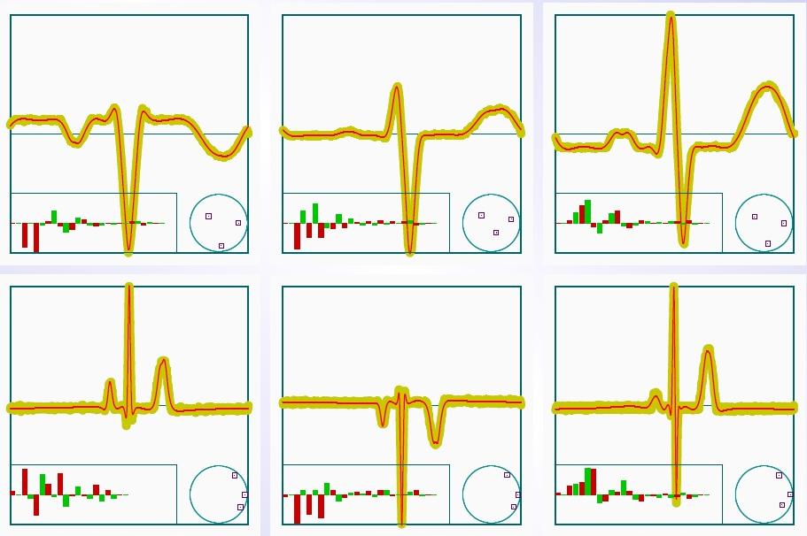 EKG görbék