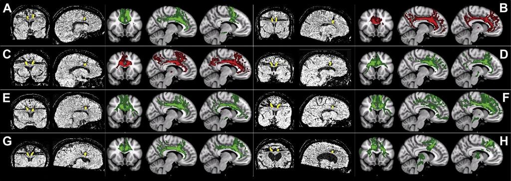 TECHNIKAI FEJLŐDÉS A DBS ALKALMAZÁSÁ BAN A target pontok pontos meghatározása probabilisztikus traktográfiával Stimulálva az ANTERIOR CINGULATE CORTEX TERÜLETEKET, melyeknek szoros összeköttetései