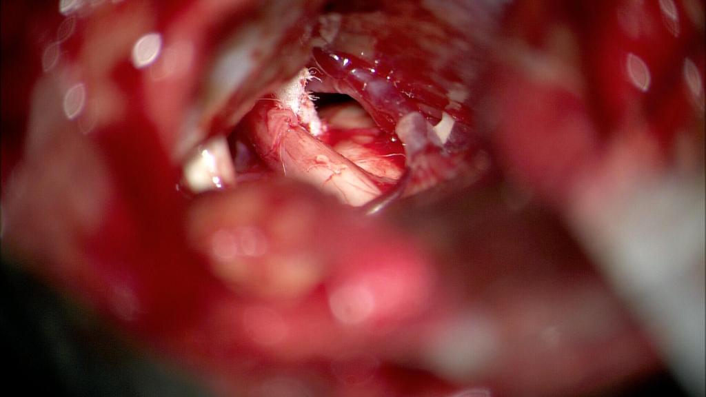 TRIGEMINUS NEURALGIA