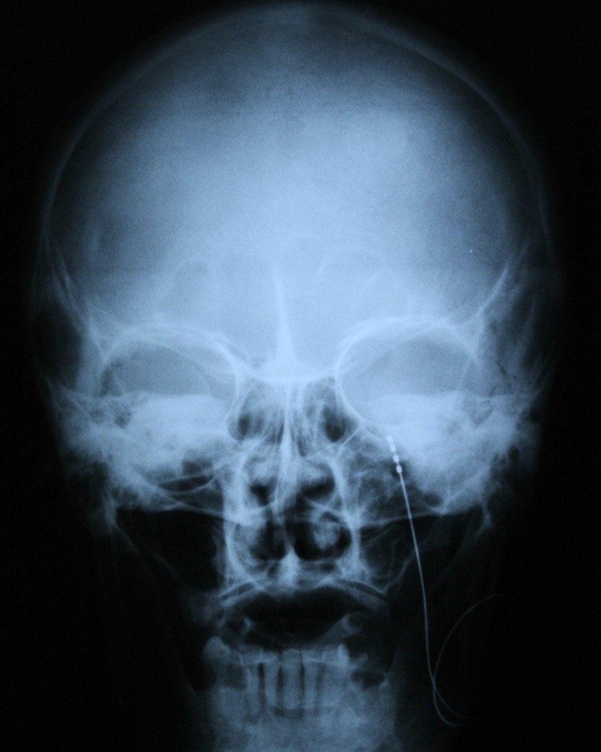 GASSER DÚC STIMULÁCIÓ Shelden 1967, Meyerson 1980: subtemporalis, epiduralis, percutan cervicalis, transz-foramen magnum elektróda beültetés Hartel módszer foramen ovale Nem alkalmazható tic