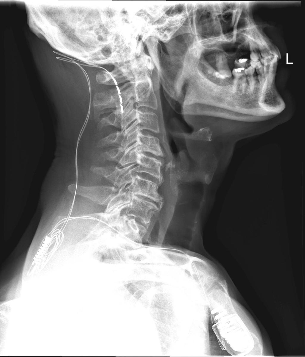 TRAKTUS A