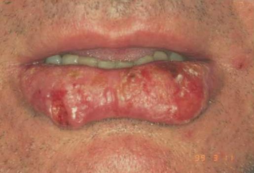 CHEILITIS ACTINICA