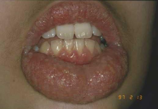 CHEILITIS