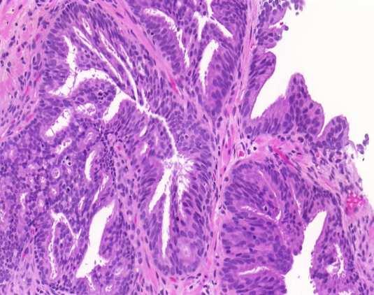 Ductal ACC vs Intraductal Pr.