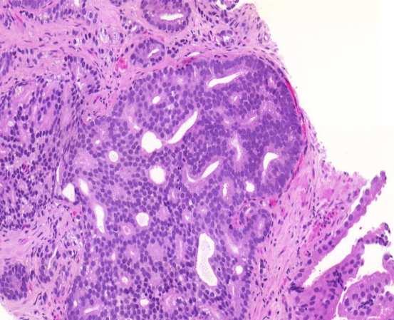 Pseudostratified columnar cells Papillary fronds Basal cells variably