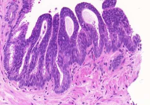 Prostatic duct ACC (Endometrioid) Papillary Solid papillary Solid nests