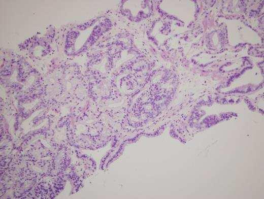 Cribriform Acinar ACC vs Cribriform Intraductal Pr.CC. Cribriform Acinar ACC Cribriform Intraductal Pr.