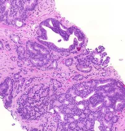 glands Can be larger than normal glands Irregular infiltrative borders ABSENCE