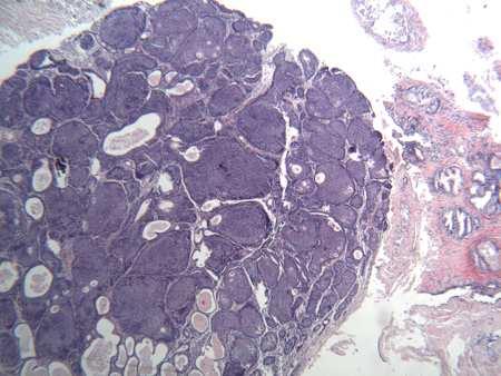 Basal sejtes carcinoma - Ki67 %-t,