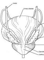 Radicalis prostatectomia Két különálló, különböző score-t mutató tumor-góc Grade-jét külön kell megadni 4+4 Different tumor nodules in a radical prostatectomy specimen are assigned different Gleason