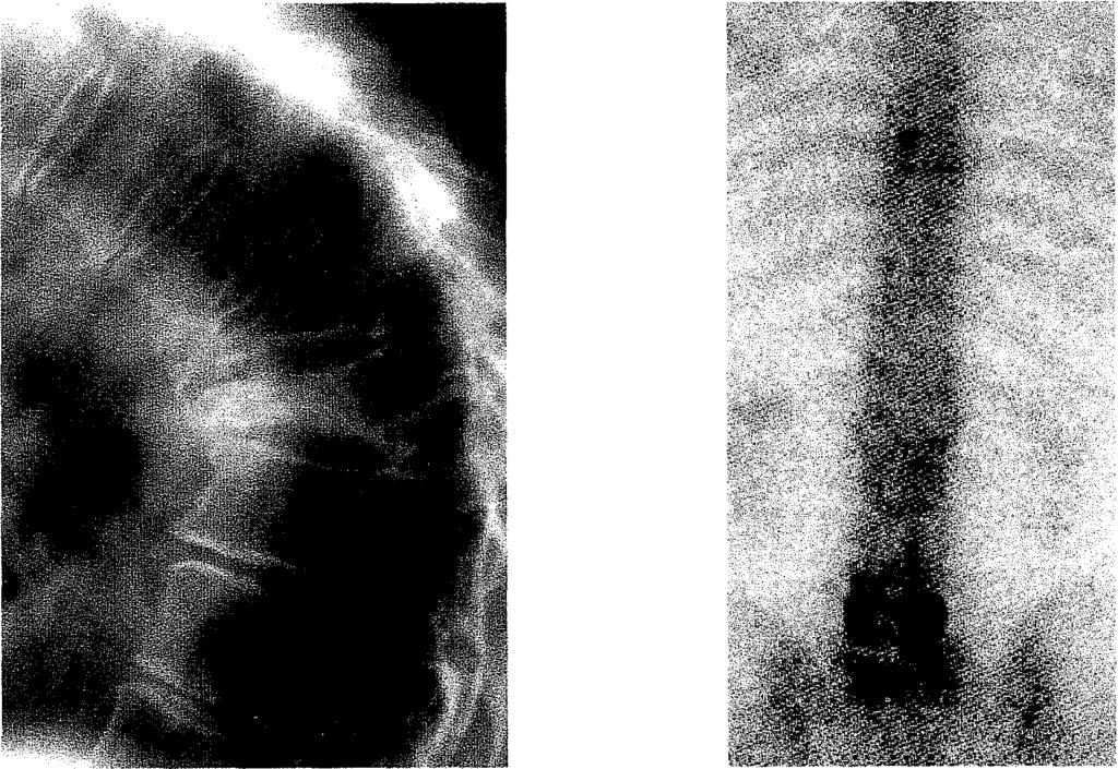 5.1.1.1. Szubjektív panasz A csigolyakompresszió miatti fájdalom, figyelembe véve a gerinc afferens beidegzésének jellegzetességeit (lásd lent), nemcsak helyi, hanem kisugárzó is lehet, mely