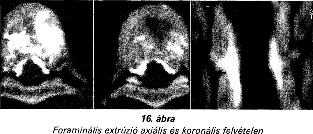 ) Az intradiszkális forma jellegzetesen kompakt csontcement akkumulációban nyilvánul meg a korong centrumában a zárólemez vagy már meglévő szakadása, vagy az injektálás során