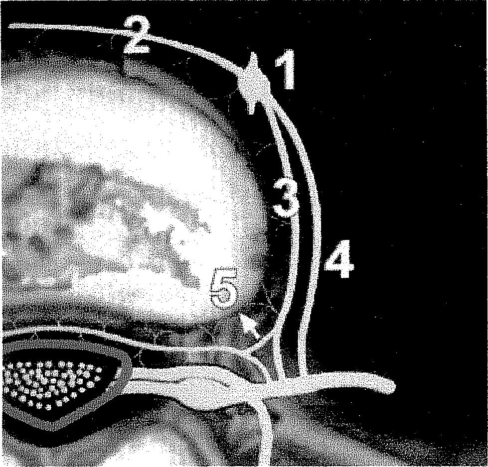 34. ábra 1 - symp.ggl. 2 - ventrális paraspinális autonóm ramus 3 - r.comm.griseus 4-r.comm. albus 5 - öszekötő ág a n. sinuvertebralis és a r.