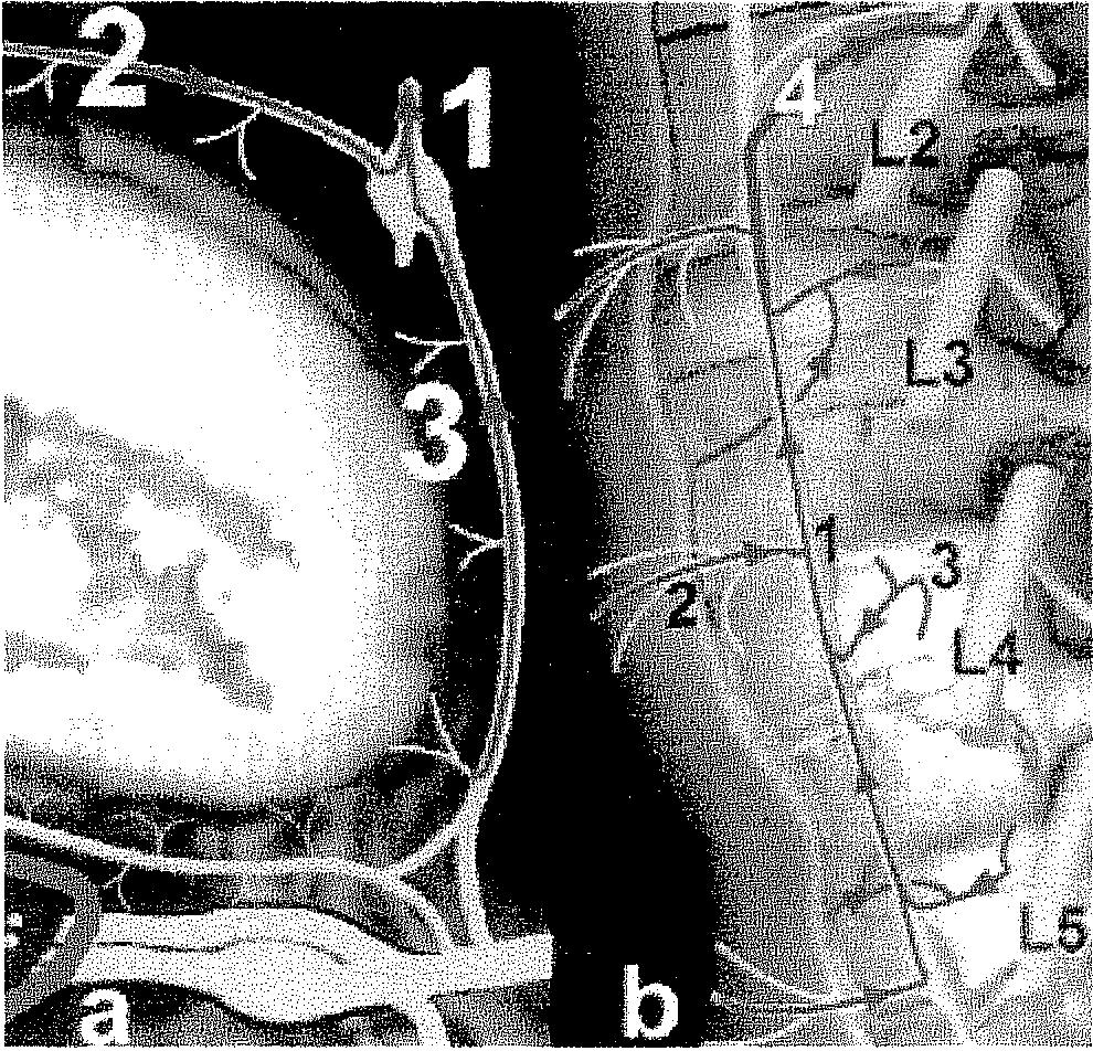 ) A hátsó hosszanti szalagot, az anulus dorzális részét, a durazsák ventrális és oldalsó területeit, valamint a kilépő gyökök duraborítékát a