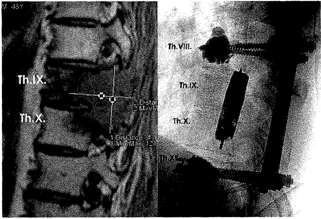 44. ábra Th.lX.-X. metasztázis MR és intraoperatív fluoroszkópiás képe. A tumorágyat csontcement blokk tölti ki; a csavarokat befogadó Th. Vili. és Th.