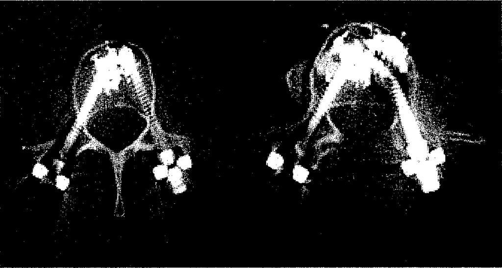 kompressziós törés preoperatív és VP utáni CT felvétele Bevatkozásainkat iderendszerileg tünetmentes betegeknél végeztük; szcintigráfiás vizsgálat mindhárom esetben izotóp akkumulációt jelzett a