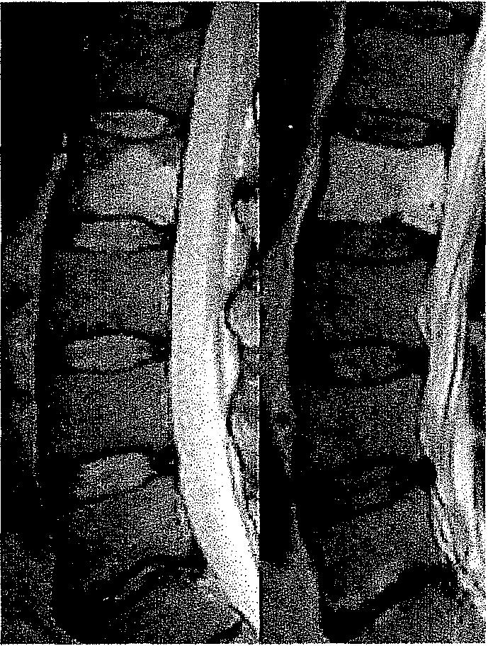 7.4. CSIGOLYATEST HEMANGIOMA A csigolyatest hemangiómák jóindulatú elváltozások, (97) melyek gyakran véletlenül, illetve a szokványos gerincpanaszok miatti átvizsgálás során kerülnek felfedezésre.