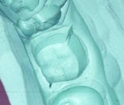 Elfolyási barázda Kaál szélé lévő ayagfelesleg eltávolítása