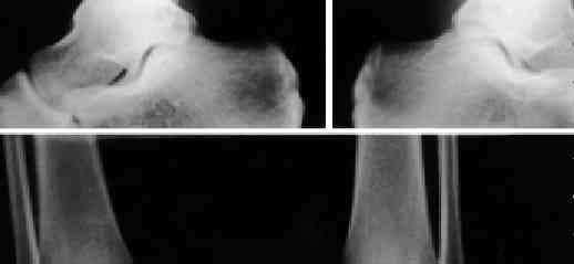 A physis teljes záródása után a sérült oldalon az ízületi kongruencia azonos az ellenoldalival, hosszkülönbség nincs. MEGBESZÉLÉS A Tillaux-törés, a két- és háromrészes triplane-töréssel, az ún.