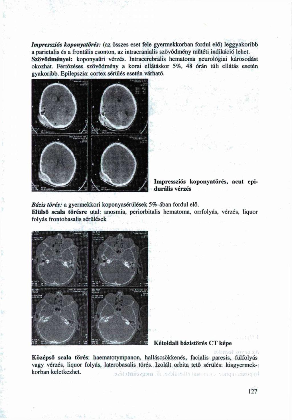 Impressziói kpnyatörés: (az összes eset fele gyermekkrban frdul elő) leggyakribb a parietalis és a frntális csntn, az intracranialis szövődmény műtéti indikáció lehet. Szövődményei: kpnyaüri vérzés.