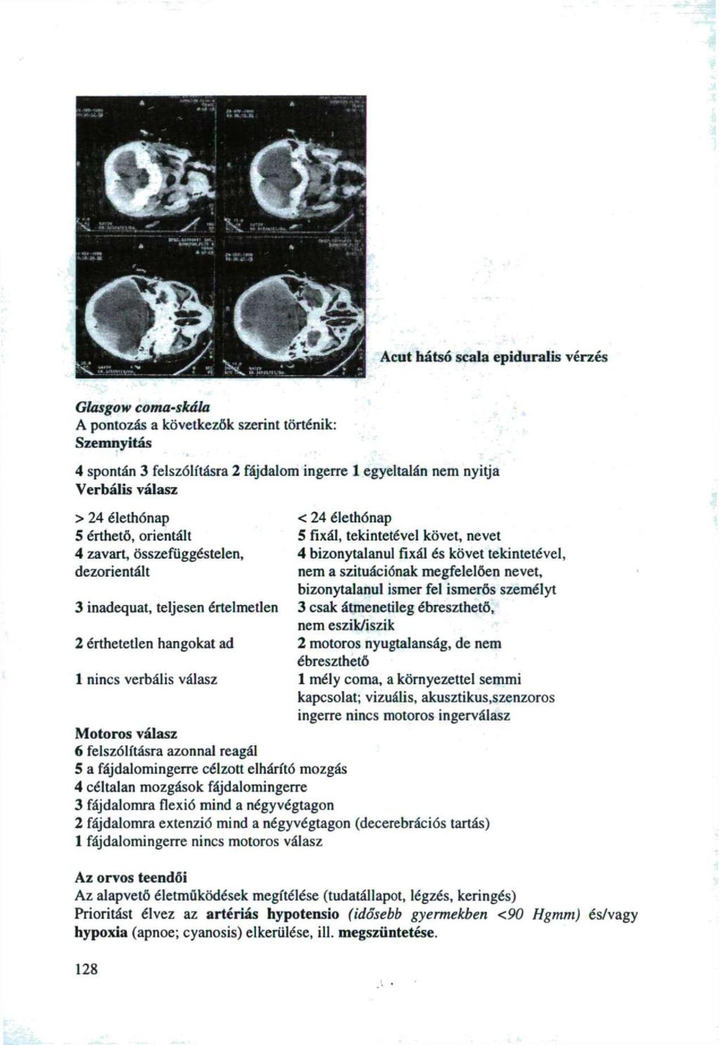 Acut hátsó scala epidu ralis vérzés Glasgw cma-skála A pntzás a következők szerint történik: Szemnyitás 4 spntán 3 felszólításra 2 fájdalm ingerre 1 egyeltalán nem nyitja Verbális válasz > 24
