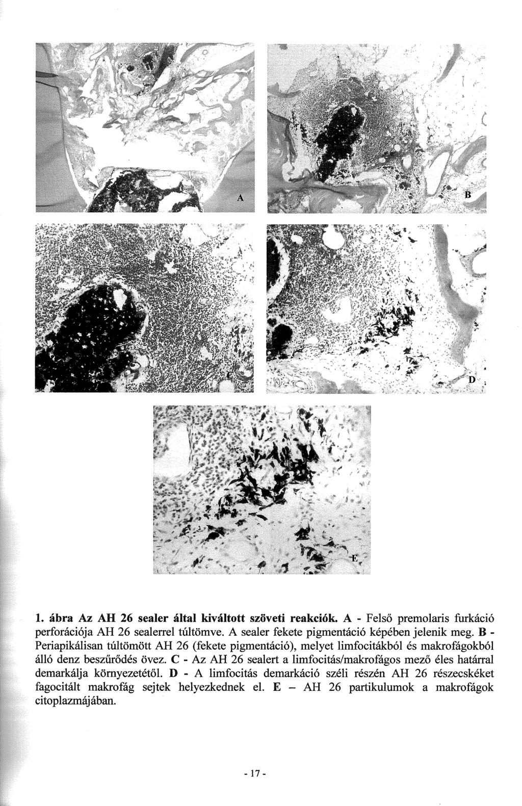 1. ábra Az AH 26 sealer által kiváltott szöveti reakciók. A - Felső premolaris furkáció perforációja AH 26 sealerrel túltömve. A sealer fekete pigmentáció képében jelenik meg.