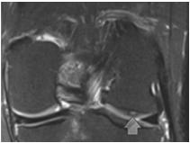 with loss of layered differentiation Nonspecific finding T2