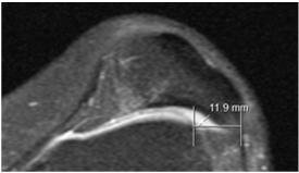 Tilt: A patella axiális síkban mért leghosszabb