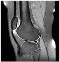 Patella alta(insall-salvati >1.3-1.