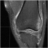 Patella luxáció, strukturális elváltozások A patello-femorális ízület