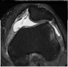 contusiója Osteochondrális sérülés, szabad ízületitest Hydrops MPFL