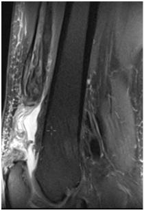 Peritendonitis Jumper s knee DDx: Mb.