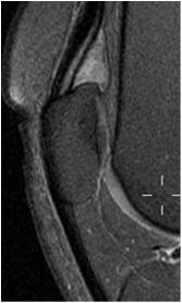 Lig. mucosum (inferior