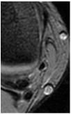 Tibialis oldalszalag