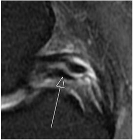 intercondylaris