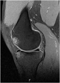 Lipohemarthrosis