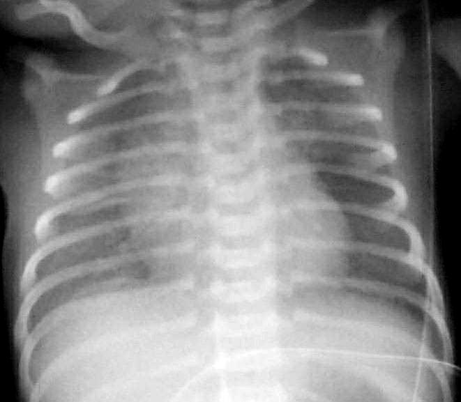 Wet lung - nedves tüdıt syndróma Alveolaris folyadék elhúzódó felszívódása sa Diabeteses anyák, sectió után n
