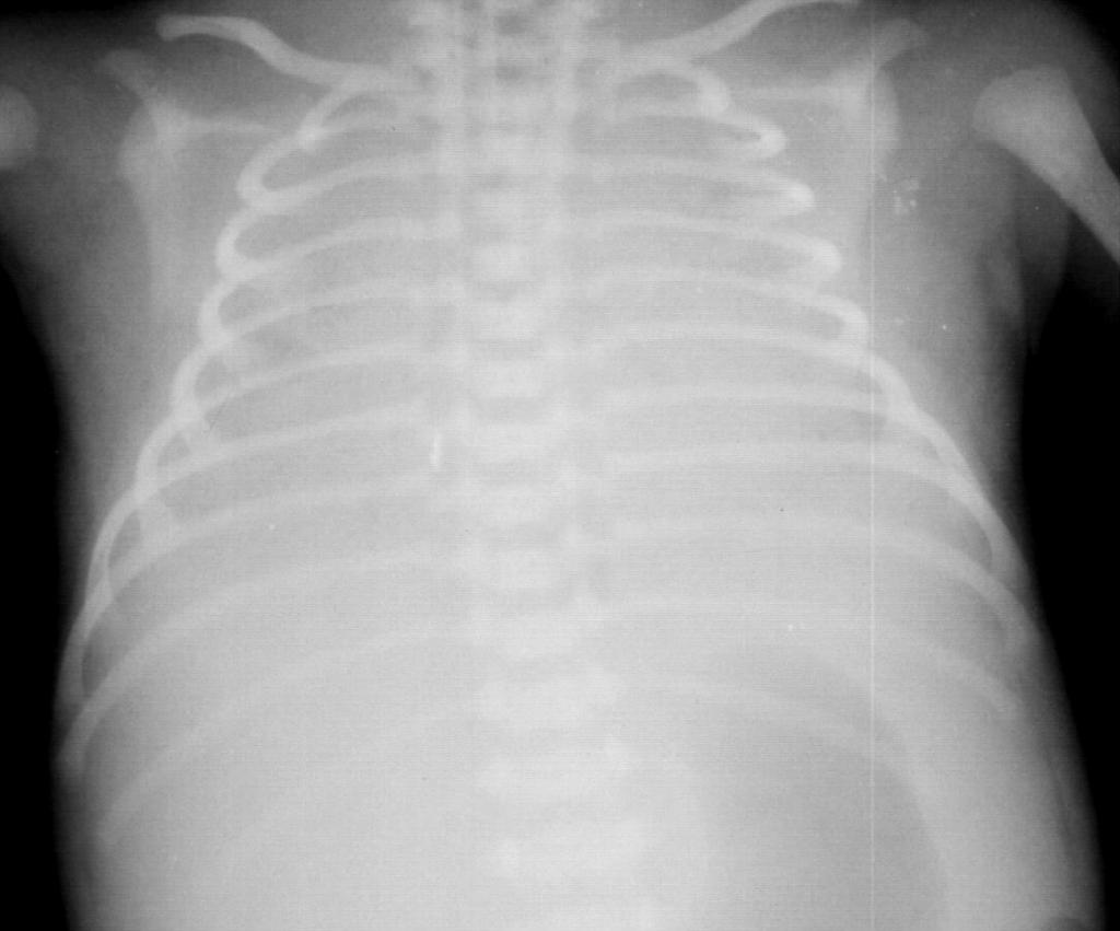 IRDS Reticulogranuláris ris rajzolat- levegıbronchogram Kezdeti rtg kép p lehet normális